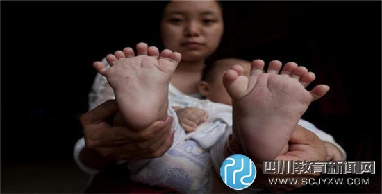 3个月大男婴患"多指症" 手指脚趾总共