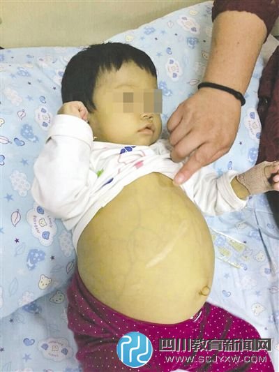 四川一14个月大女孩患病 肚子胀大如气球