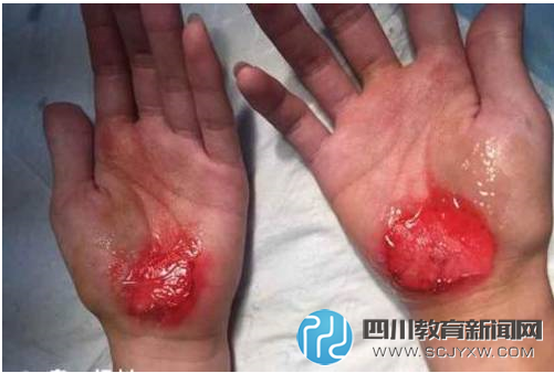 深圳高中生遭体罚用手走路 双手血肉模糊(图)
