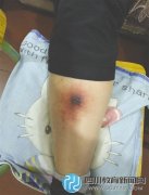 成都一学校校工被虫咬一口 被下病危通知